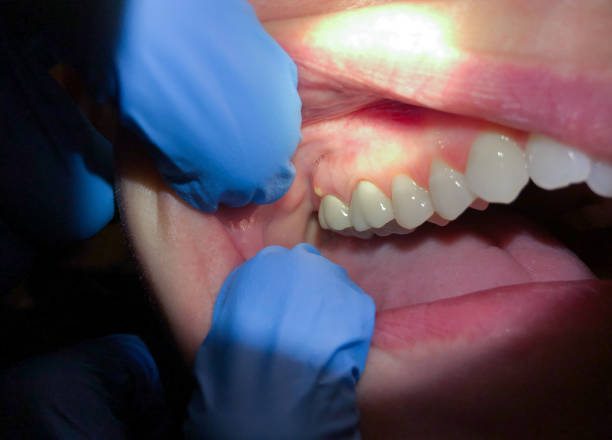Best Emergency Dentist for Lost Fillings or Crowns in Brigham City, UT