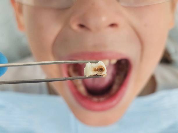 Best Emergency Dental Extractions in Brigham City, UT